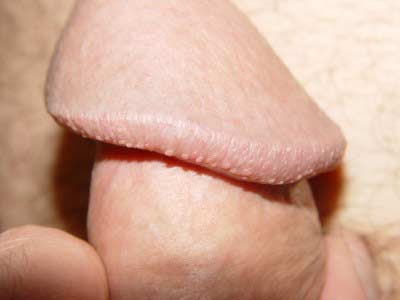 t_pearly_penile_papules_1_0.jpg
